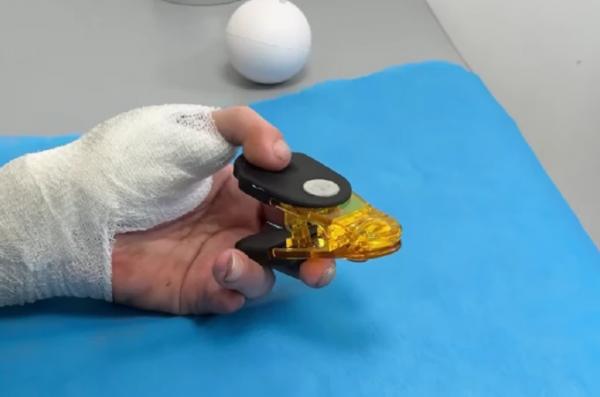 У львівському центрі Superhumans військовому пересадили палець із ноги на руку